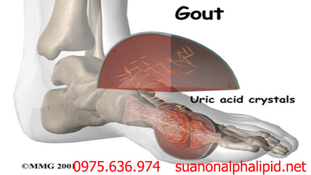 Nguyên nhân gây bệnh gout